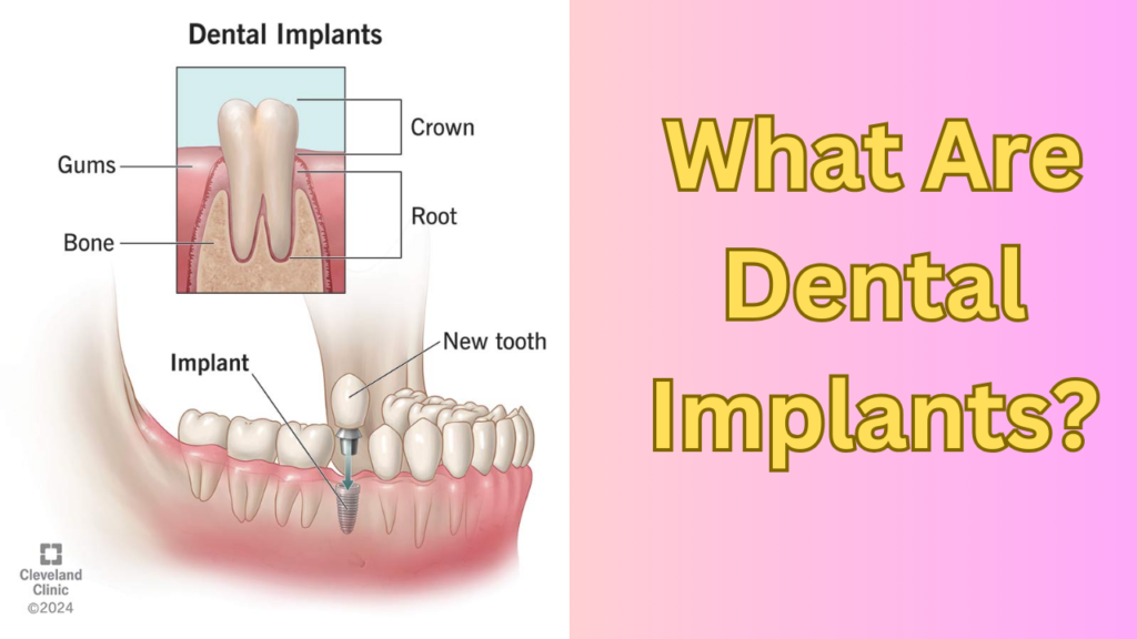 What Are Dental Implants?