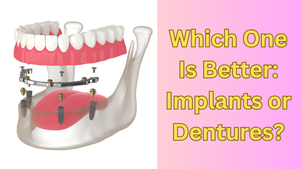 Which One Is Better: Implants or Dentures?