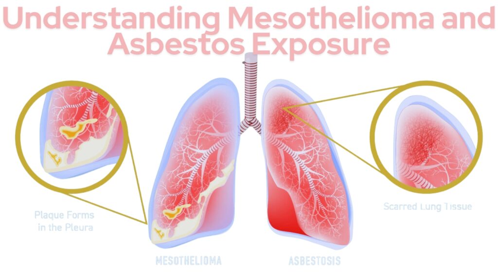 Understanding Mesothelioma and Asbestos Exposure